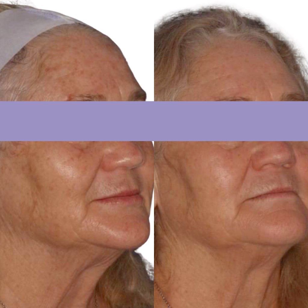 Photodynamic PDT Therapy before and after at Coastal Skin & Laser Noosa