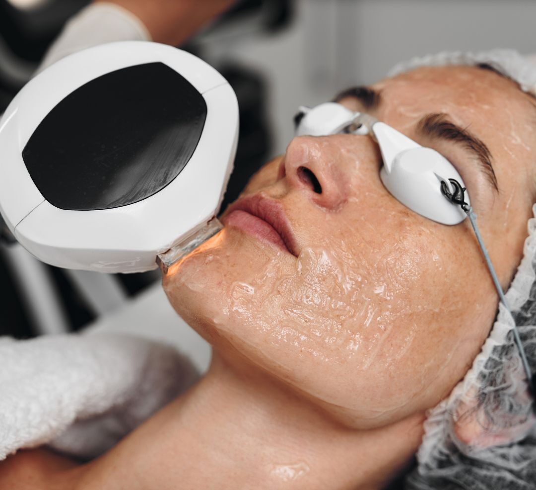IPL Skin Rejuvenation​