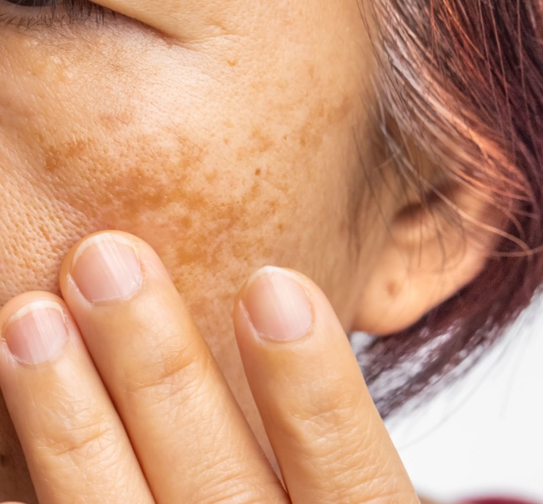 Laser Pigmentation Removal for sunspots, melamasma and more