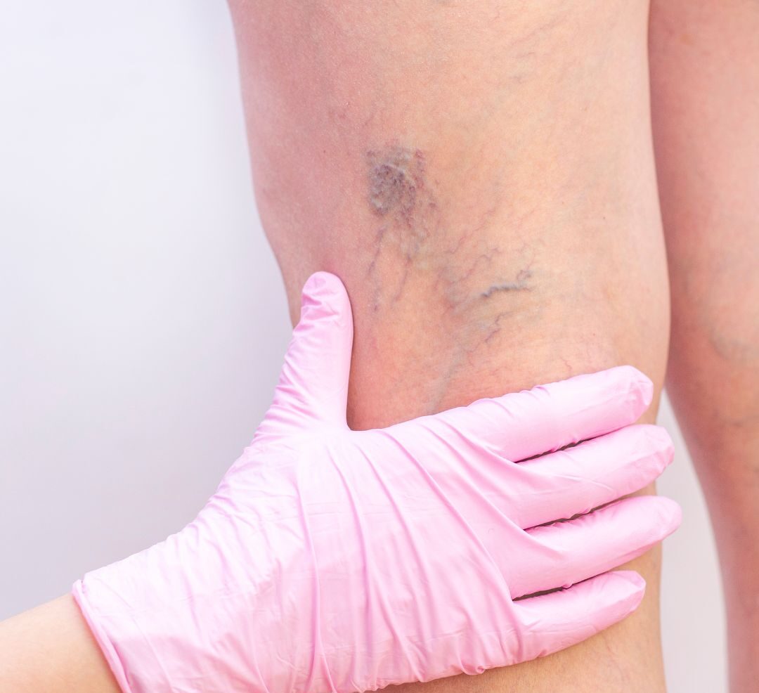 Laser Vein Removal for spider veins and more