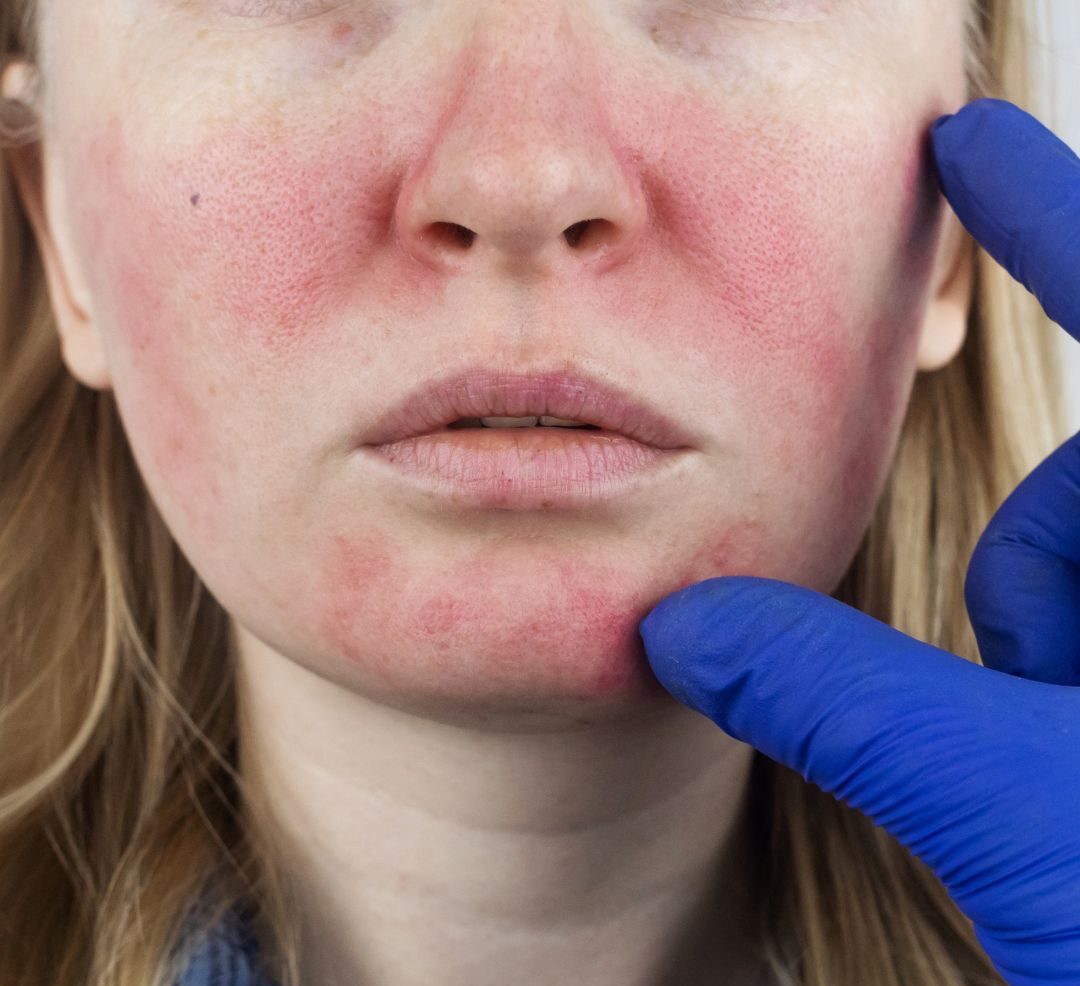 Vascular Laser Treatment for facial redness and more