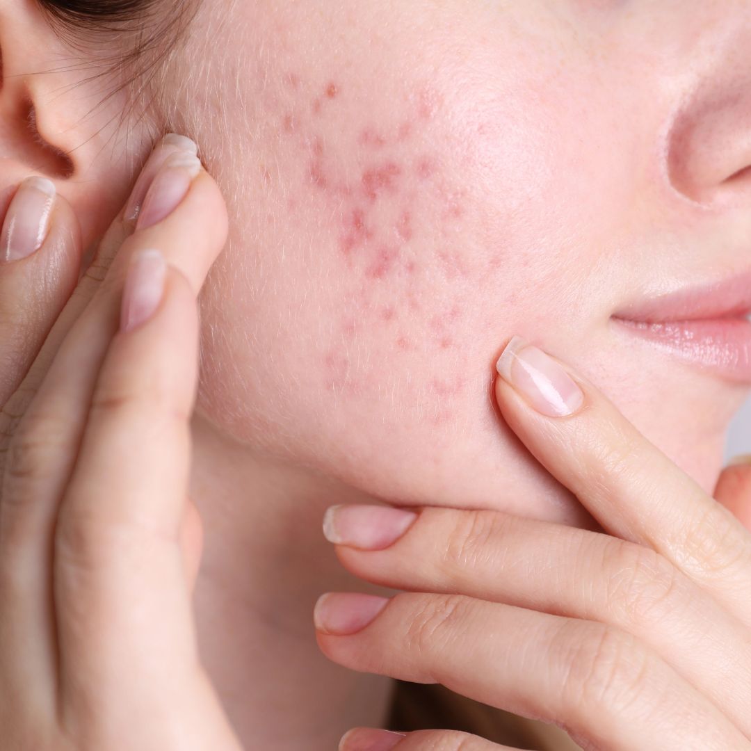 face with red bumby acne scars