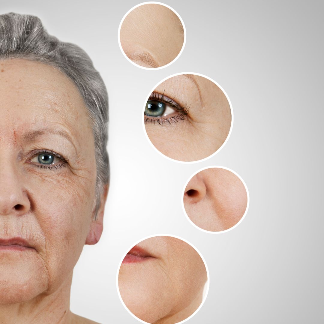 treatment for facial fine lines and wrinkles