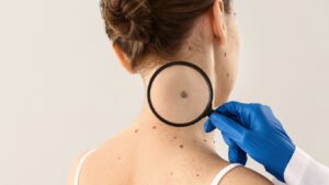 Cosmetic and Medical mole removal