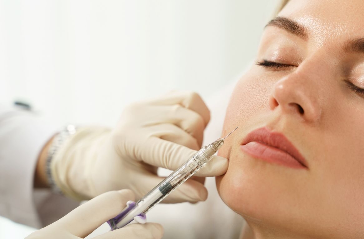 dermal fillers for nasobial folds